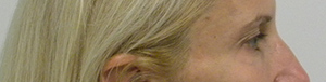 Eyelid Surgery Case 8856 Before Photo Eyelid Surgery