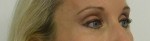 Eyelid Surgery