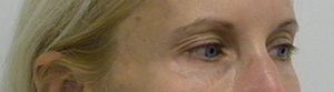 Eyelid Surgery Case 8856 Before Photo Eyelid Surgery