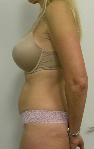 Tummy tuck (Abdominoplasty)