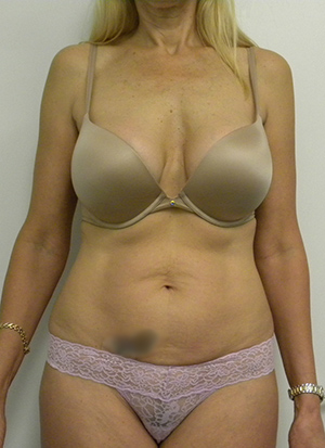 Tummy tuck (Abdominoplasty)