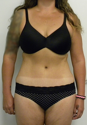 Tummy tuck (Abdominoplasty)