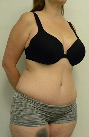 Tummy tuck (Abdominoplasty) Case 8896 After Photo Tummy tuck (Abdominoplasty)