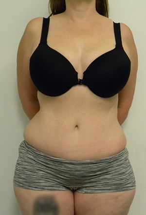 Tummy tuck (Abdominoplasty)