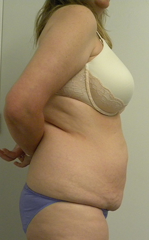 Tummy tuck (Abdominoplasty) Case 8896 Before Photo Tummy tuck (Abdominoplasty)