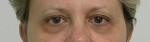 Eyelid Surgery