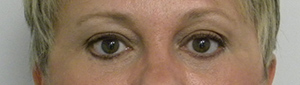 Eyelid Surgery Case 8908 After Photo Eyelid Surgery