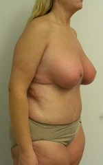 Mommy Makeover