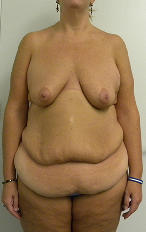 Mommy Makeover Case 8912 Before Photo Mommy Makeover