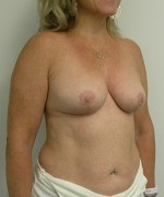 Breast Reduction