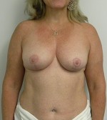 Breast Reduction