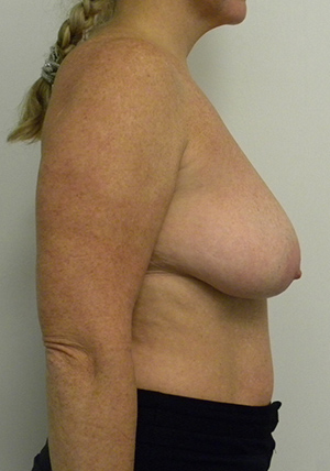 Breast Reduction Case 8920 Before Photo Breast Reduction