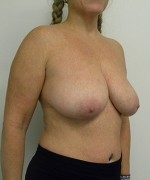 Breast Reduction