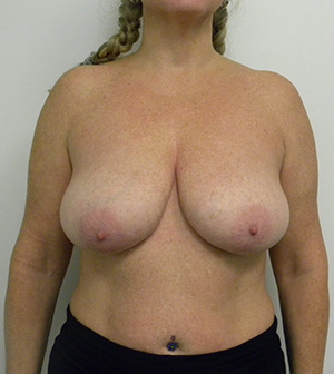 Breast Lift Case 8928 Before Photo Breast Lift