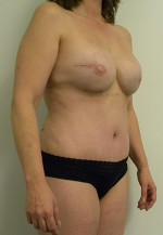 Mommy Makeover