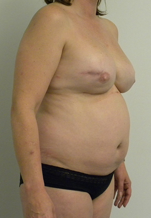 Tummy tuck (Abdominoplasty) Case 8944 Before Photo Tummy tuck (Abdominoplasty)