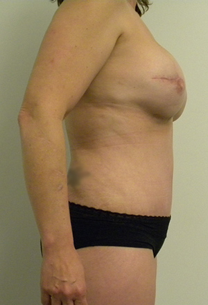 Tummy tuck (Abdominoplasty)