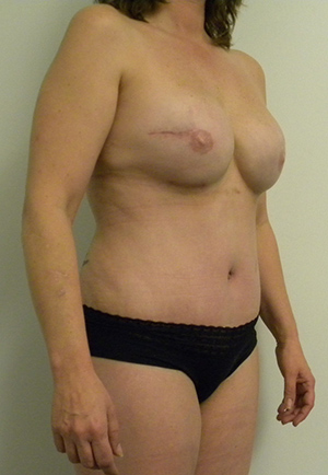 Tummy tuck (Abdominoplasty)