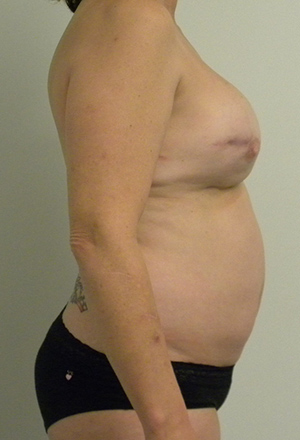 Breast Reconstruction Case 8952 Before Photo Breast Reconstruction