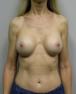 Breast Augmentation