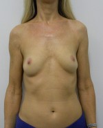 Breast Augmentation