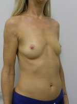 Breast Augmentation
