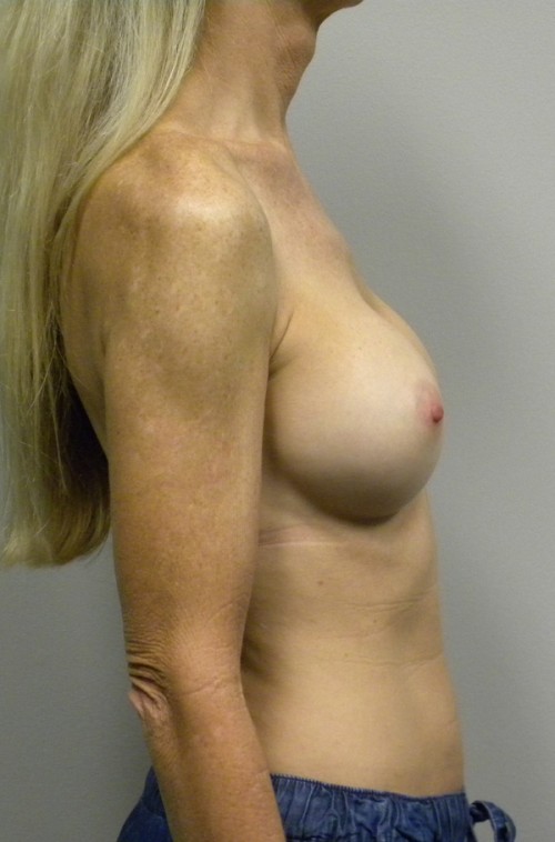 Breast Augmentation Case 9041 After Photo Breast Augmentation