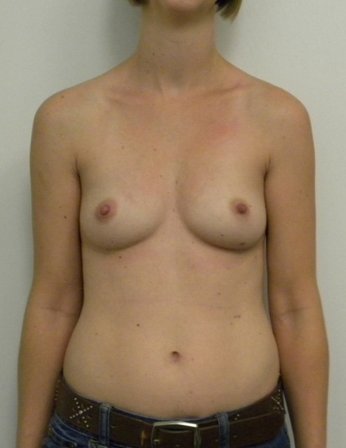Breast Augmentation Case 9050 Before Photo Breast Augmentation