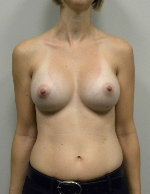 Breast Augmentation Case 9050 After Photo Breast Augmentation