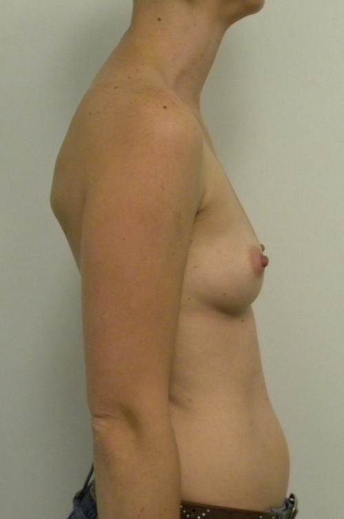 Breast Augmentation Case 9050 Before Photo Breast Augmentation
