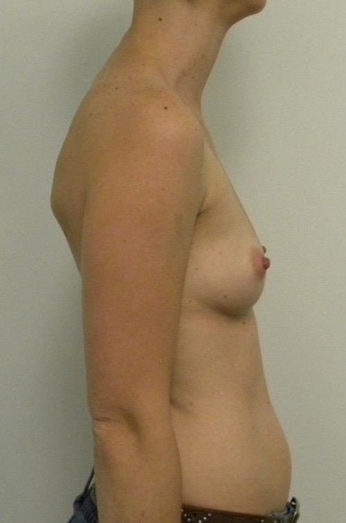 Breast Augmentation