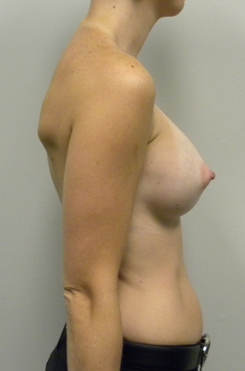 Breast Augmentation Case 9050 After Photo Breast Augmentation
