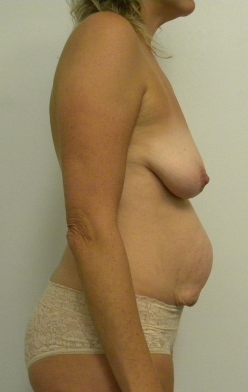 Breast Augmentation Case 9058 Before Photo Breast Augmentation