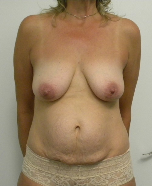 Breast Augmentation Case 9058 Before Photo Breast Augmentation