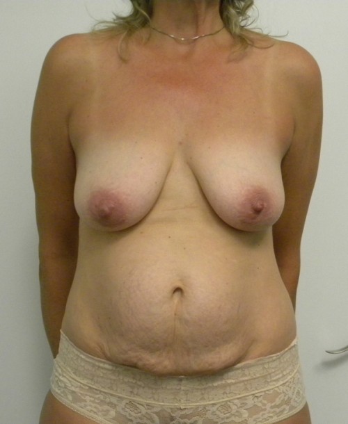 Breast Augmentation