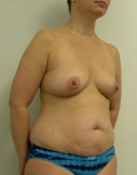 Breast Augmentation