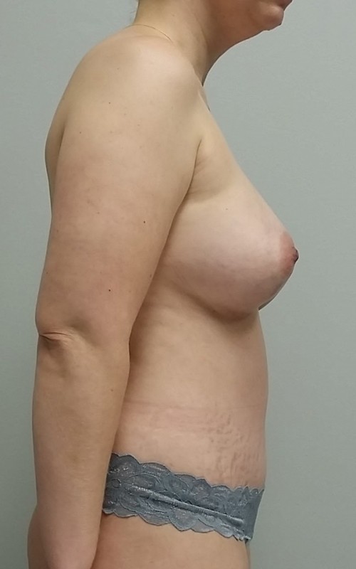 Breast Augmentation Case 9066 After Photo Breast Augmentation