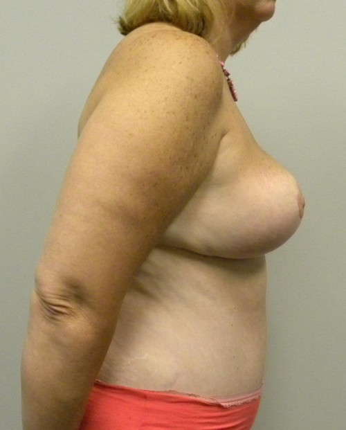 Breast Reduction Case 9082 After Photo Breast Reduction