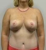 Breast Reduction