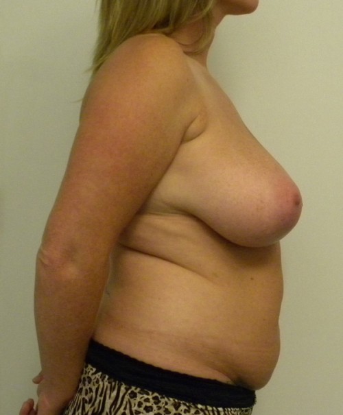 Breast Reduction Case 9090 Before Photo Breast Reduction