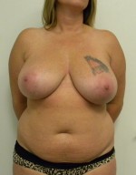 Breast Reduction