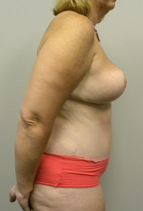 Mommy Makeover Case 9107 After Photo Mommy Makeover