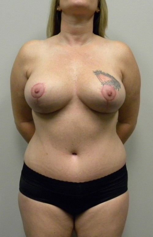 Mommy Makeover Case 9115 After Photo Mommy Makeover