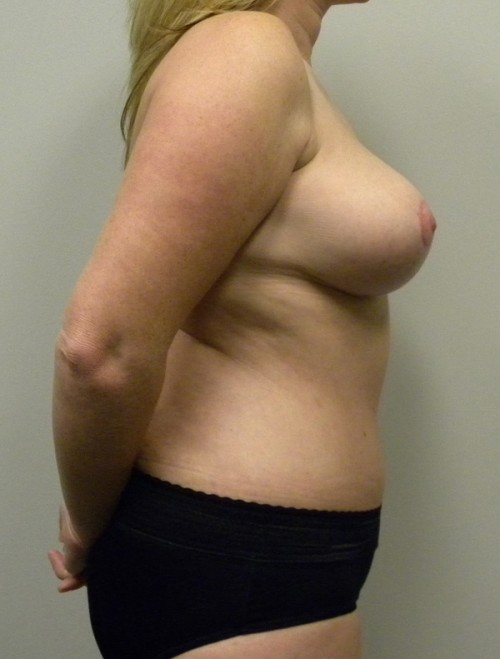Mommy Makeover Case 9115 After Photo Mommy Makeover