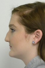 Rhinoplasty/Nose Reshaping