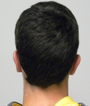 Otoplasty/Cosmetic Ear Surgery Case 9147 After Photo Otoplasty/Cosmetic Ear Surgery