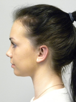 Otoplasty/Cosmetic Ear Surgery Case 9153 After Photo Otoplasty/Cosmetic Ear Surgery