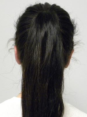 Otoplasty/Cosmetic Ear Surgery Case 9153 After Photo Otoplasty/Cosmetic Ear Surgery
