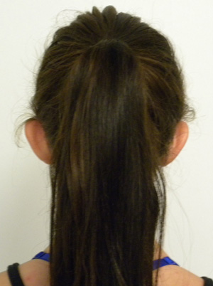 Otoplasty/Cosmetic Ear Surgery Case 9153 Before Photo Otoplasty/Cosmetic Ear Surgery