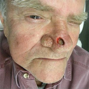 Skin Cancer Reconstruction Case 9161 Before Photo Skin Cancer Reconstruction